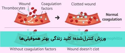 ورزش کنترلشده؛ کلید زندگی بهتر هموفیلیها