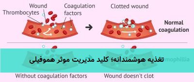 تغذیه هوشمندانه؛ کلید مدیریت موثر هموفیلی