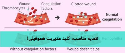 تغذیه مناسب، کلید مدیریت هموفیلی!