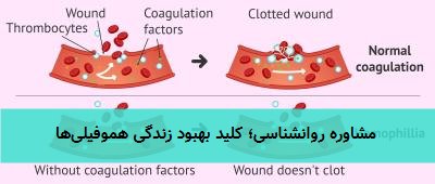  مشاوره روانشناسی؛ کلید بهبود زندگی هموفیلی‌ها 