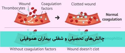  چالش‌های تحصیلی و شغلی بیماران هموفیلی 