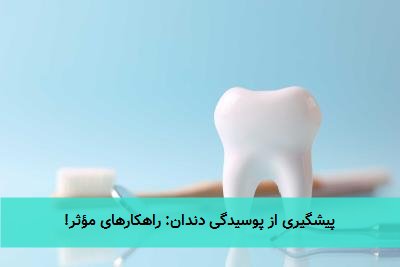 پیشگیری از پوسیدگی دندان: راهکارهای مؤثر!