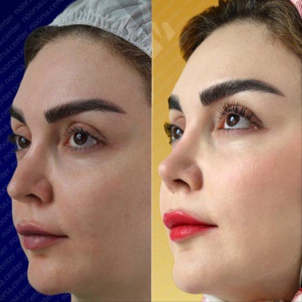 جراحی بینی طبیعی