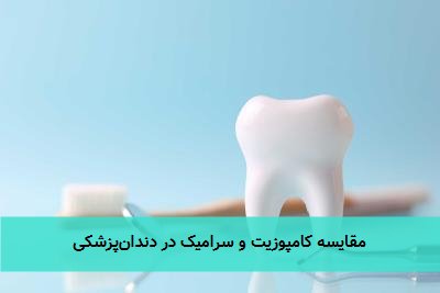 مقایسه کامپوزیت و سرامیک در دندان‌پزشکی