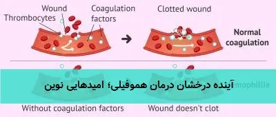 آینده درخشان درمان هموفیلی؛ امیدهایی نوین