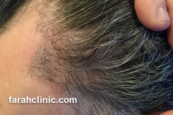 بهترین مرکز کاشت مو در تهران کجاست؟