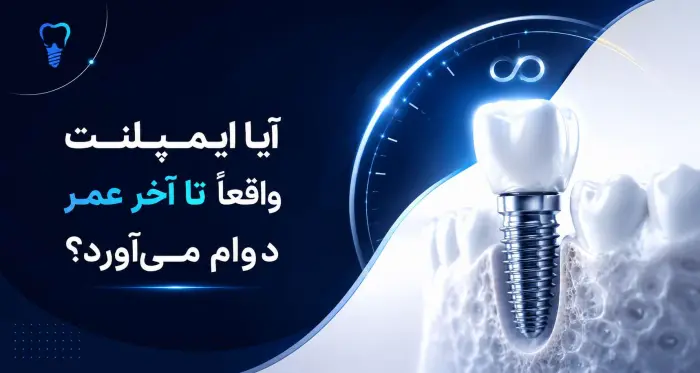 ایمپلنت دندان دائمی است؟ همه چیز درباره طول عمر و ماندگاری آن