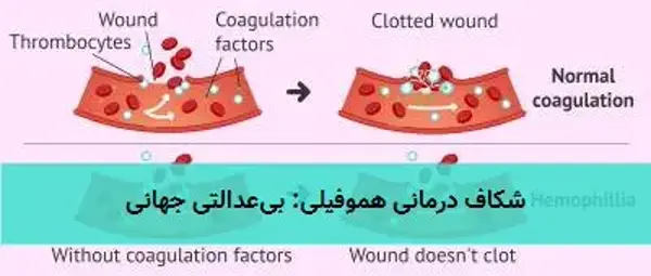 شکاف درمانی هموفیلی: بی‌عدالتی جهانی