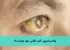 واکسیناسیون کلید طلایی مهار هپاتیت A