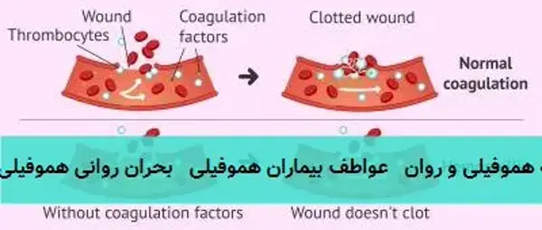 هموفیلی و سلامت روان رابطه هموفیلی و روان عواطف بیماران هموفیلی بحران روانی هموفیلی هموفیلی: چالشهای ... هموفیلی و سلامت روان رابطه هموفیلی و روان عواطف بیماران هموفیلی بحران روانی هموفیلی هموفیلی: چالشهای ...